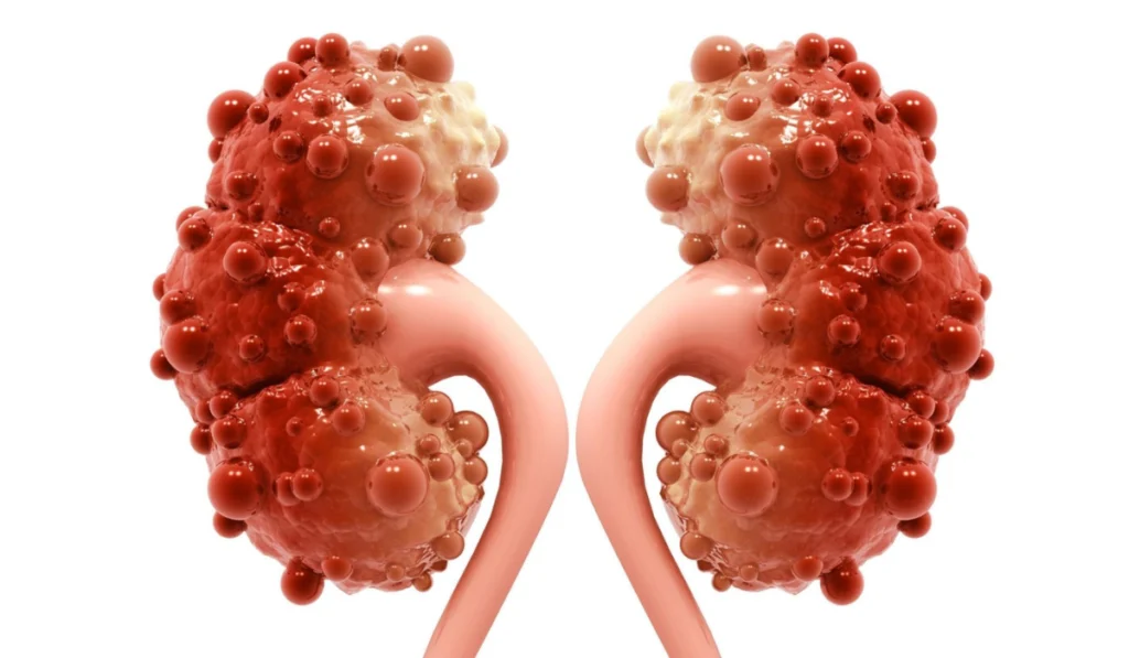 enfermedad-renal-poliquistica