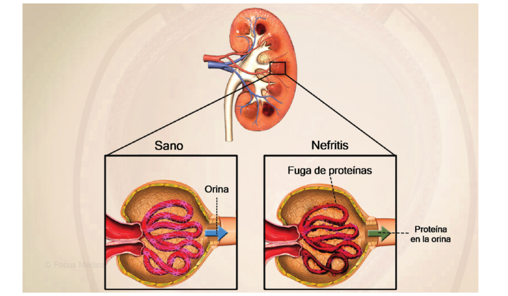 nefritis-que-es-problemas-de-rinones